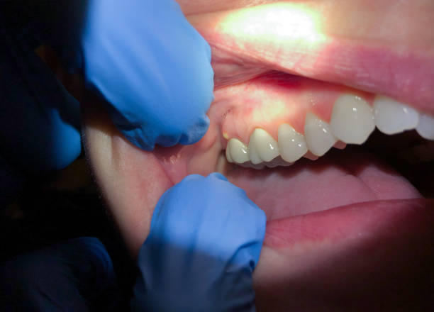 Best Emergency Dental Extractions in Fall River, MA